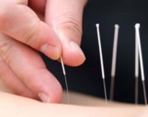 Alternatieve geneeswijze acupunctuur